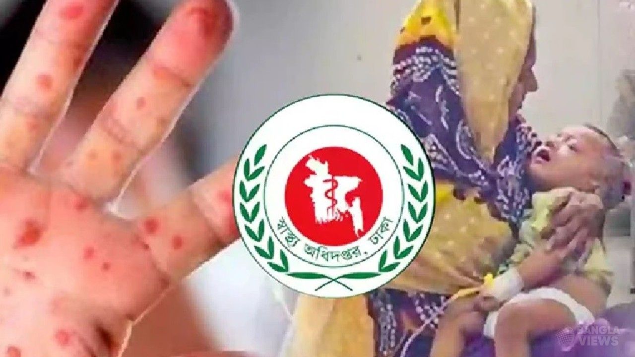 দেশে আবারও বিশেষ হাম টিকাদান কর্মসূচি, টিকা পাবে ৩৪ লাখ শিশু